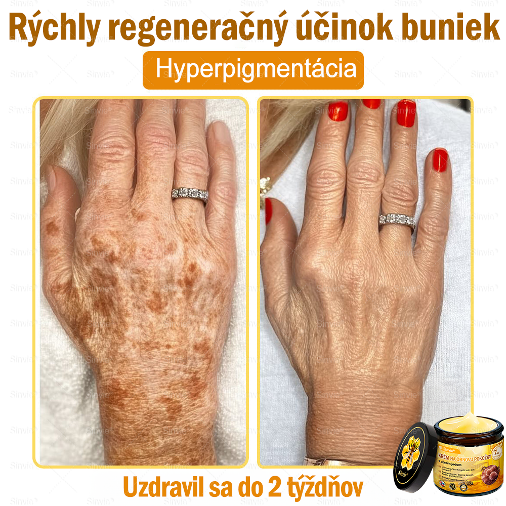 🌻🌻 Sinvie® Krém na obnovu pokožky s včelím jedom 🔥 Odporúčané dermatológmi | Proti vráskam, pigmentovým škvrnám a ochabnutej pokožke – 50 ml