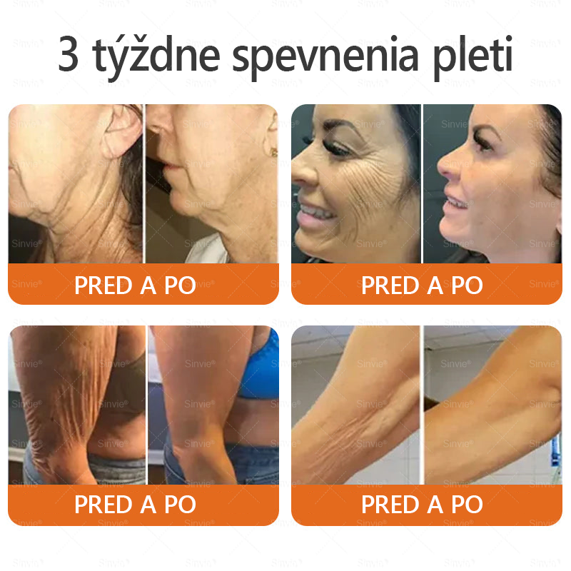 🌻🌻 Sinvie® Krém na obnovu pokožky s včelím jedom 🔥 Odporúčané dermatológmi | Proti vráskam, pigmentovým škvrnám a ochabnutej pokožke – 50 ml