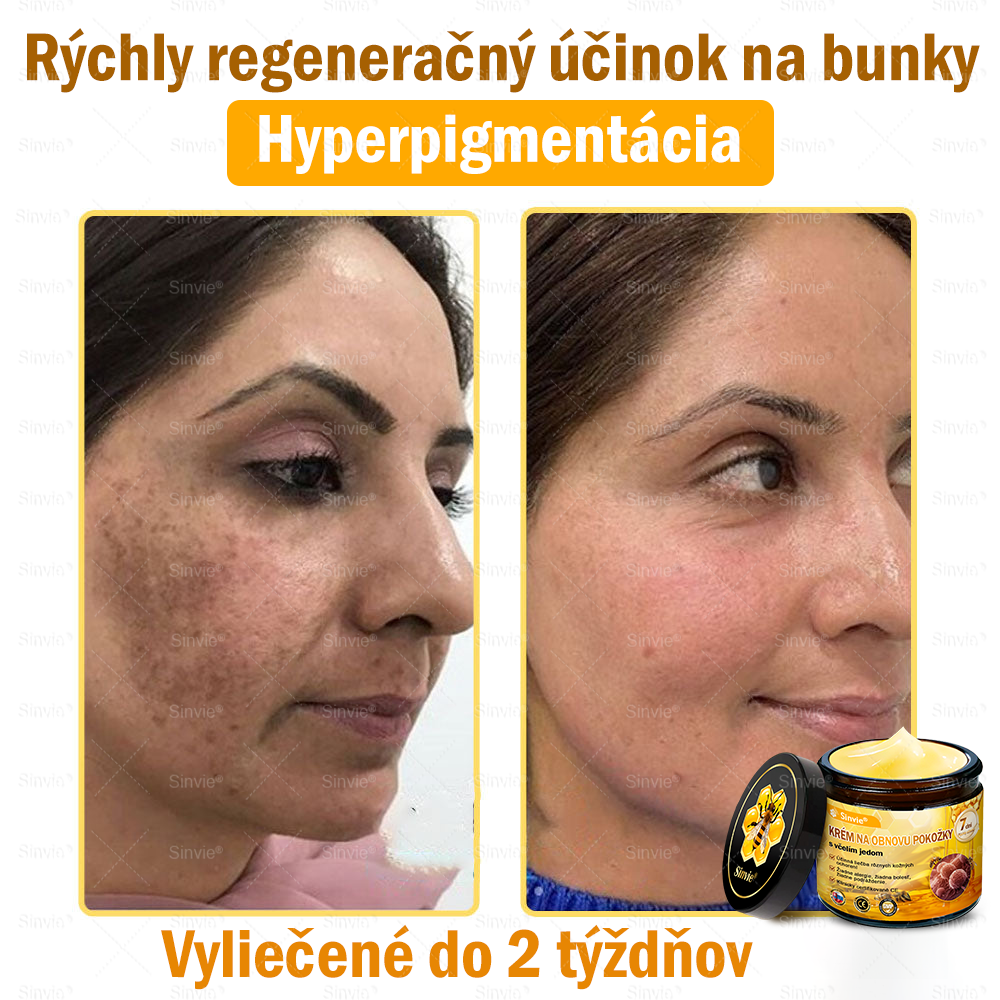 🌻🌻 Sinvie® Krém na obnovu pokožky s včelím jedom 🔥 Odporúčané dermatológmi | Proti vráskam, pigmentovým škvrnám a ochabnutej pokožke – 50 ml